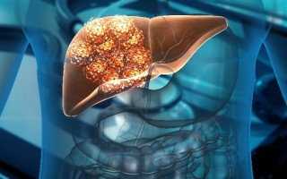 Steatoepatite, infiammazione e danno al fegato
