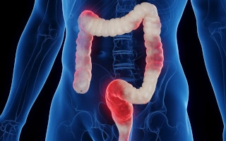 Sindrome del intestino irritabile