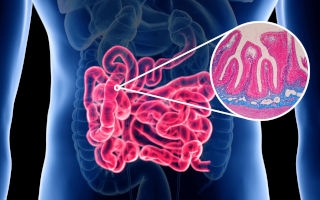 Sindrome dell'Intestino Permeabile