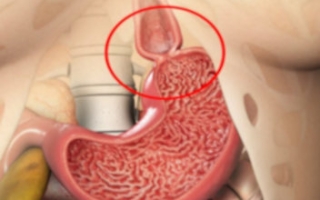 Acalasia